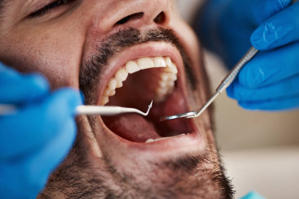 Best Emergency Wisdom Teeth Removal in Baldwin, MI