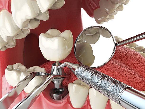 Best Emergency Root Canal Treatment in Baldwin, MI